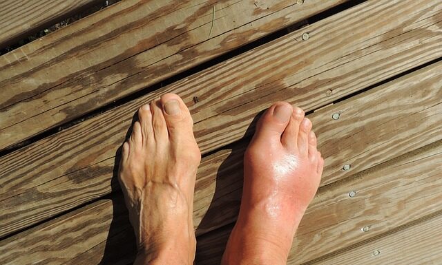 Jak leczyć płaskostopie w domu?